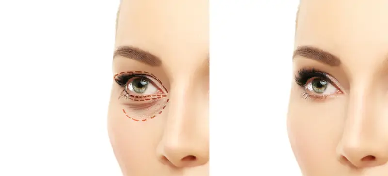 Lower Blepharoplasty