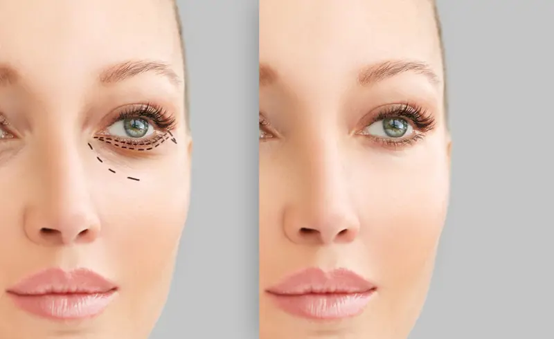 Alternatives to Lower Blepharoplasty Surgery