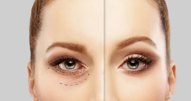 Lower Blepharoplasty Cost