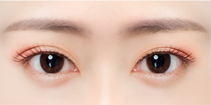 Complications of Double Eyelids Surgery