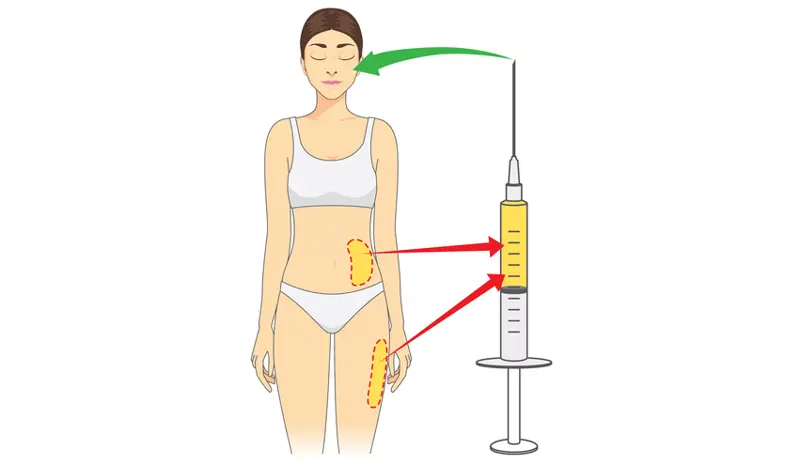 Micro Fat Graft