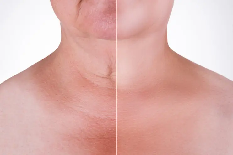 Types of Neck Lifts