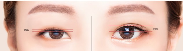 Ptosis Repair Surgery