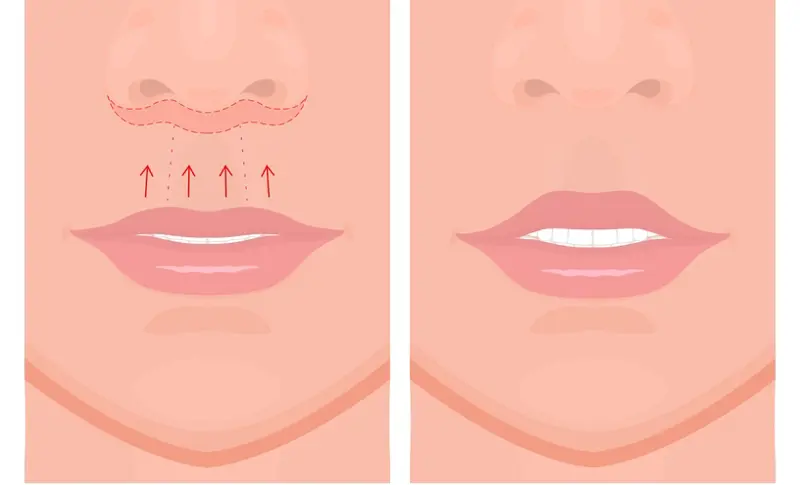 lips lift