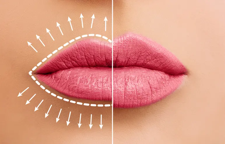 Lip Filler Benefits